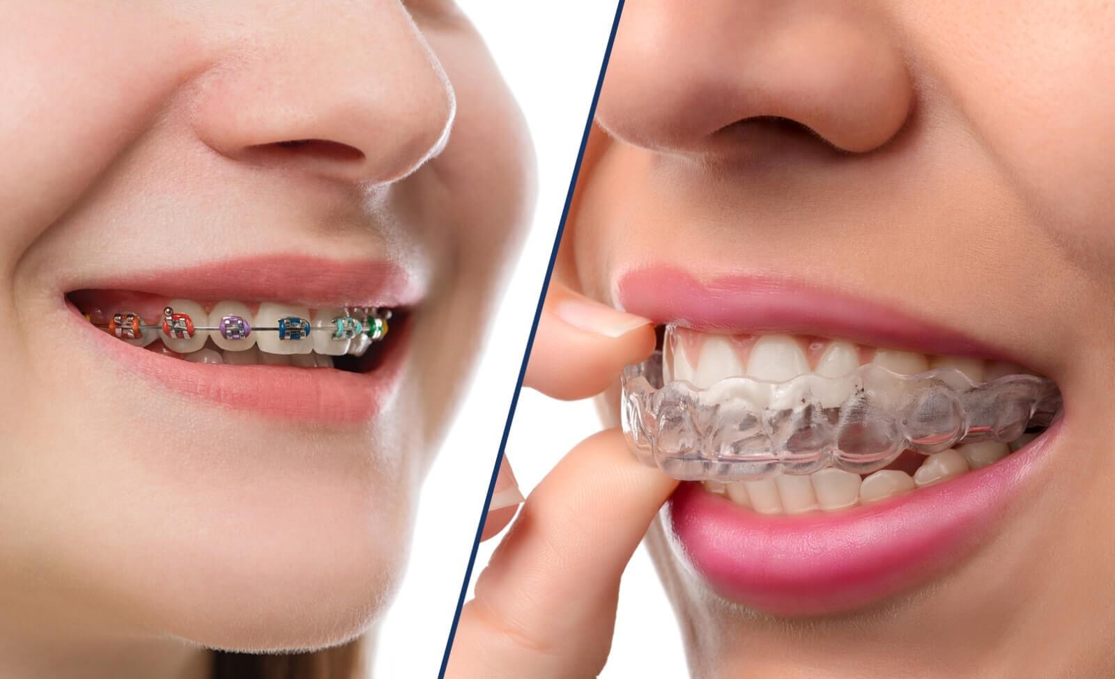 Braces vs. Invisalign